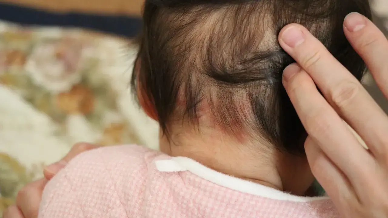Dita accarezzano la nuca di un neonato, dove si notano delle piccole macchie rosse, quasi un "morso della cicogna" che porta con sé storie di nascita.