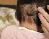 Dita accarezzano la nuca di un neonato, dove si notano delle piccole macchie rosse, quasi un "morso della cicogna" che porta con sé storie di nascita.