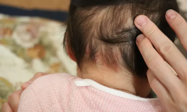 Dita accarezzano la nuca di un neonato, dove si notano delle piccole macchie rosse, quasi un "morso della cicogna" che porta con sé storie di nascita.