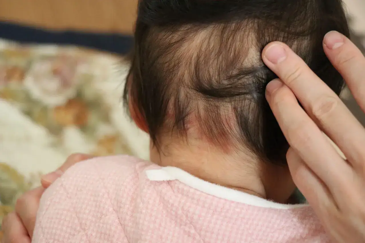 Dita accarezzano la nuca di un neonato, dove si notano delle piccole macchie rosse, quasi un